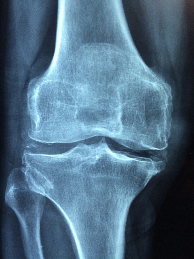 zdjęcie rentgenowskie kolana - poradnia reumatologiczna Tychy